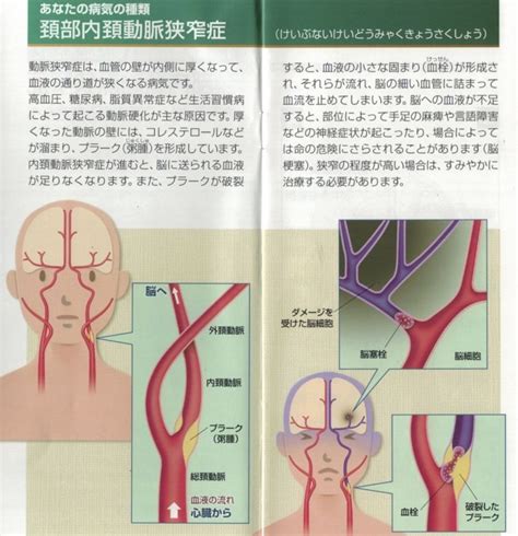 首 脈|ドックで見つかる頚動脈狭窄症って？